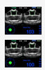 BVT02 bladder scanner, residual volume, urinary tract infection, postoperative urinary retention, catheterization