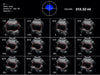 Measure Bladder Volumes with InterAktiv Scan Bladder Scanner 4D array scan