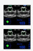 Kaixin BVT02 Portable Bladder Scanner - InterAktiv Health